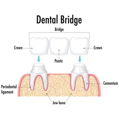 Difference between crowns and bridges