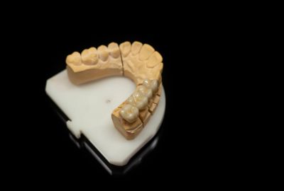 Durability dental crowns