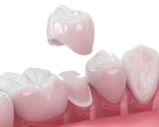 How Are Dental Crowns Attached