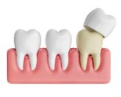 how many dental crowns does the average person have