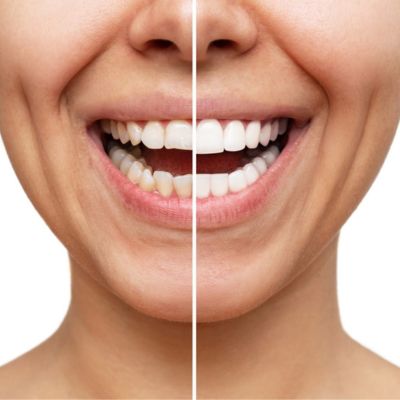 How Often Do Dental Crowns Need to Be Replaced?