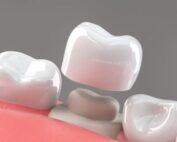 How to take care of dental crowns