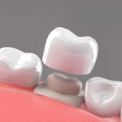 How to take care of dental crowns