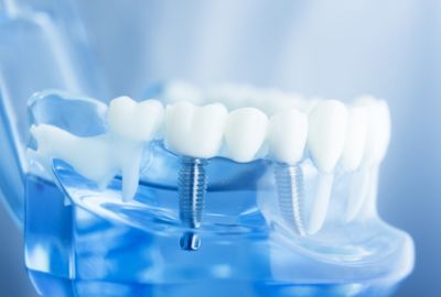 Implants alternative treatments to crowns
