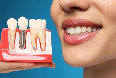 Average Lifespan Of A Dental Crown?