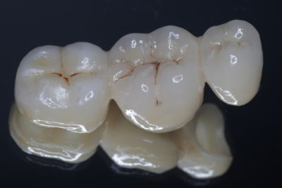 Type Lithium Disilicate (E-MAX) Crowns
