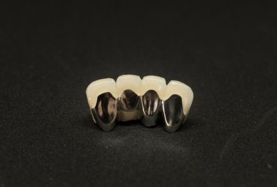 Type porcelain fused to metal crowns