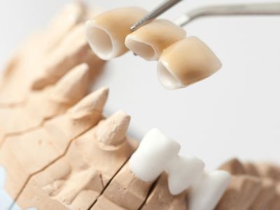 Understanding structure of dental crowns