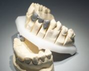 What is the best crown material for front and back teeth