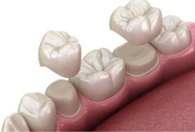 Dental crowns help protect a weak or damaged tooth