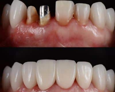 Dental crowns help restore tooth function