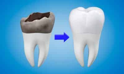 Dental crowns help with pain relief from damaged teeth