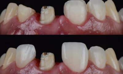 The dentist will remove some of your natural enamel before dental crowns