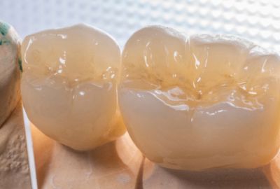 Zirconia crowns color