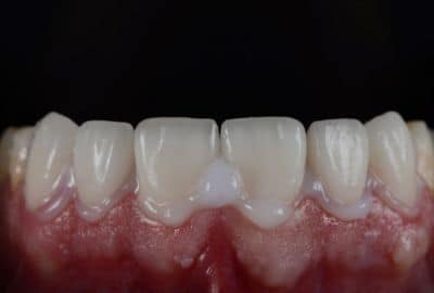 How to remove dental cement from crown at home