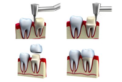 The truth about dental crowns causing cancer