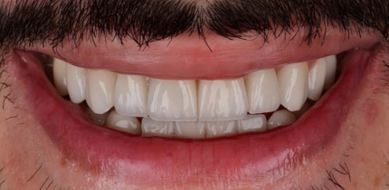 Image of front teeth after a crown