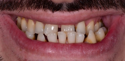 Image of front teeth before the crown