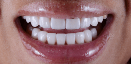 Case 1 image bottom teeth after a crown