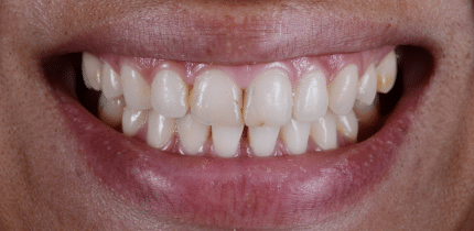 Case 1 image bottom teeth before a crown