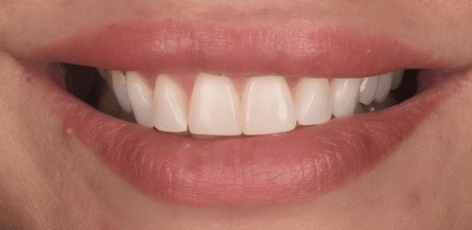 Case 1 image 2 front teeth after a crown