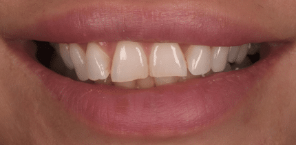 Case 1 image 2 front teeth before a crown