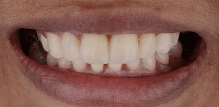 Case 1 Image 4 front teeth after a crown