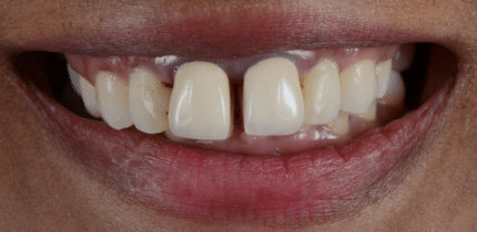 Case 1 Image 4 front teeth before a crown