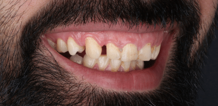 Case 1 image full mouth before the crown