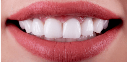 Case 1 image of 6 front teeth after crowns