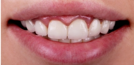 Case 1 image of 6 front teeth before crowns