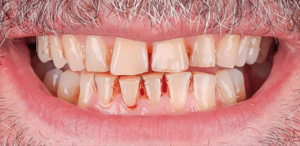 Case 2 image bottom teeth before a crown