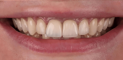 Case 2 image 2 front teeth after a crown