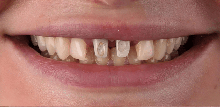 Case 2 image 2 front teeth before a crown