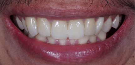 Case 2 image 4 front teeth after a crown