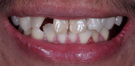 Case 2 image 4 front teeth before a crown