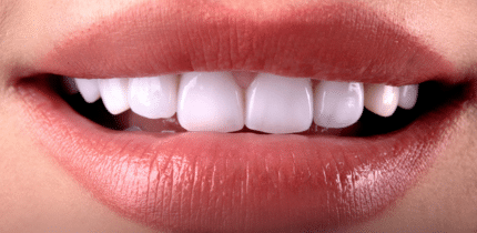 Case 2 image of 6 front teeth after crowns