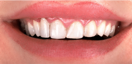 Case 2 image of 6 front teeth before crowns.