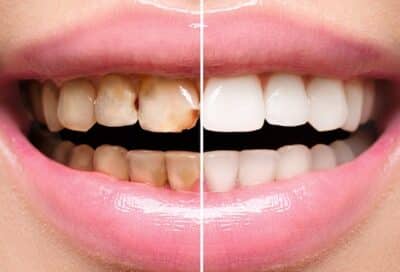 Dental crowns before and after
