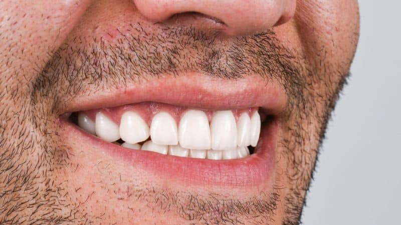High-resolution photo of an EMAX crown on a front tooth showing translucency and enamel-like texture.