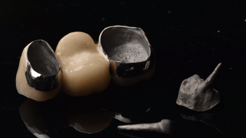 Porcelain-fused-to-metal crown showing slight gray line at gum margin.