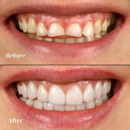 image gums before and after dental crown