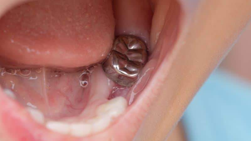 Close-up photo of a silver metal crown placed on a back molar tooth, showing its shiny surface and fit.