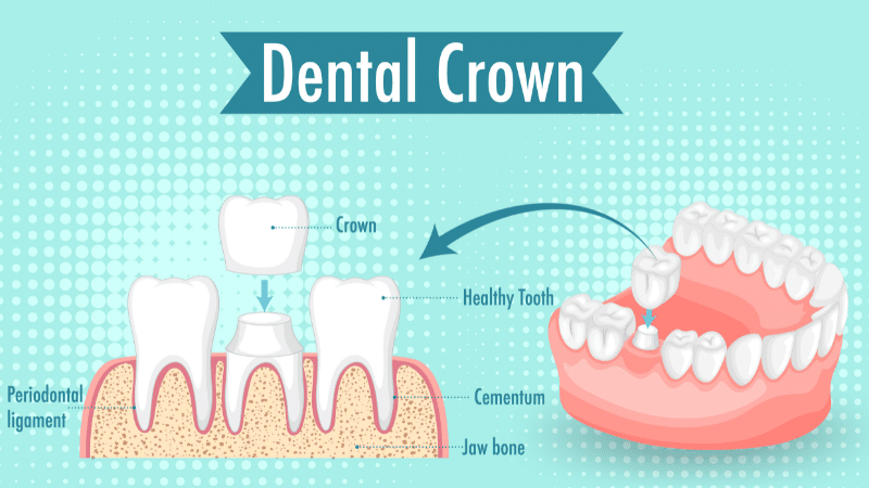 What does a dental crown look like?