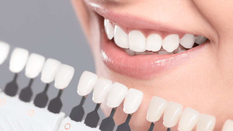 Porcelain dental crown on front tooth, high translucency, glossy enamel-like finish