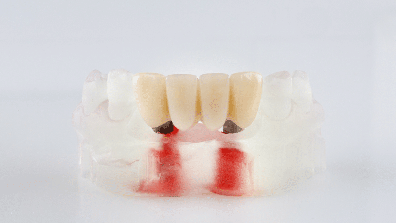 Temporary resin dental crown on prepared tooth, slightly bulky and dull in color compared to surrounding natural teeth.