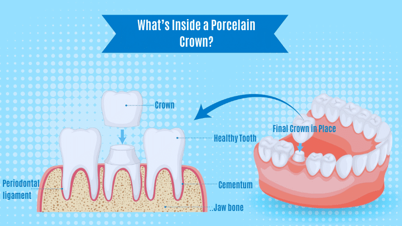 Porcelain crown placement diagram showing anatomy labels: crown, healthy tooth, cementum, and jawbone.