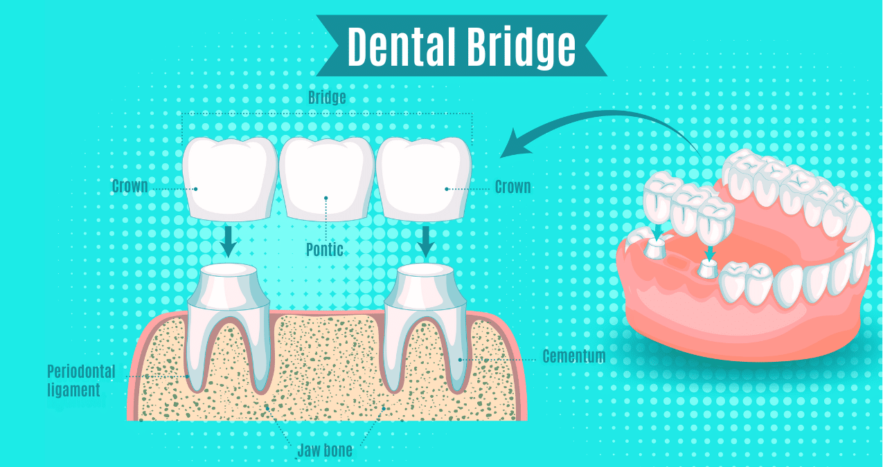 Dental bridge structure diagram showing pontic and crowns on natural teeth.