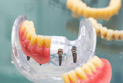How much does a mini dental implant cost?