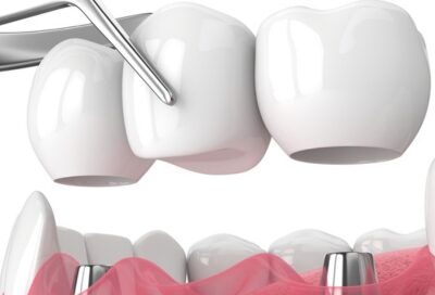 Close-up of an implant-supported dental bridge being removed for potential recementation, showing abutments and prosthetic teeth in a clinical setting.